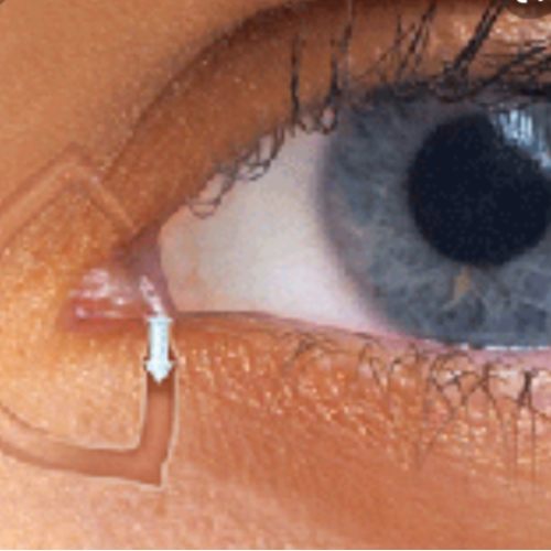 Dry Eye Clinic Abu Dhabi - Eye Plugs