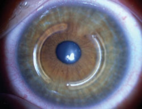 CORNEAL RINGS