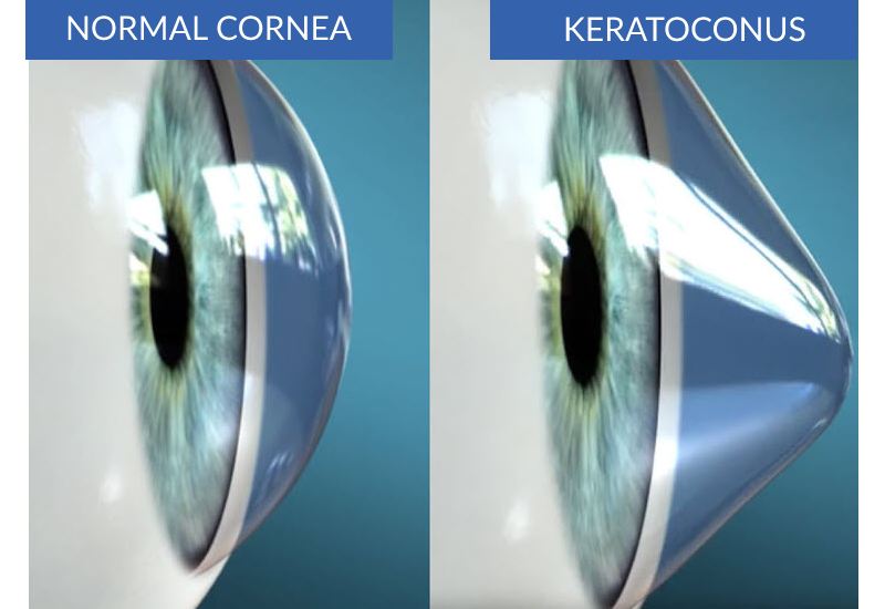 KERATOCONUS CORNEA