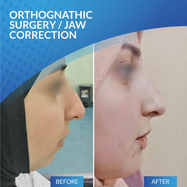 Orthognathic Surgery and Jaw Correction