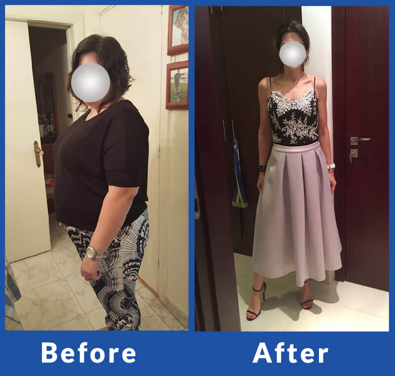 Bariatric Surgery Before after