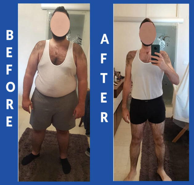 Stomach Gastric Bypass Sleeve Surgery & Support