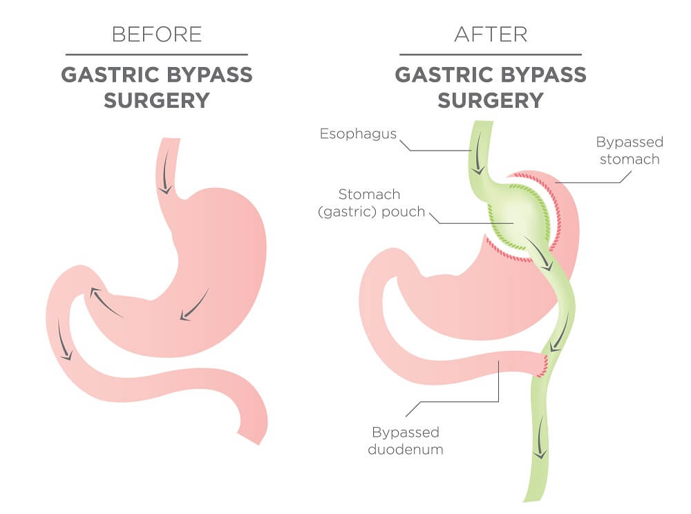 Gastric Bypass Surgery