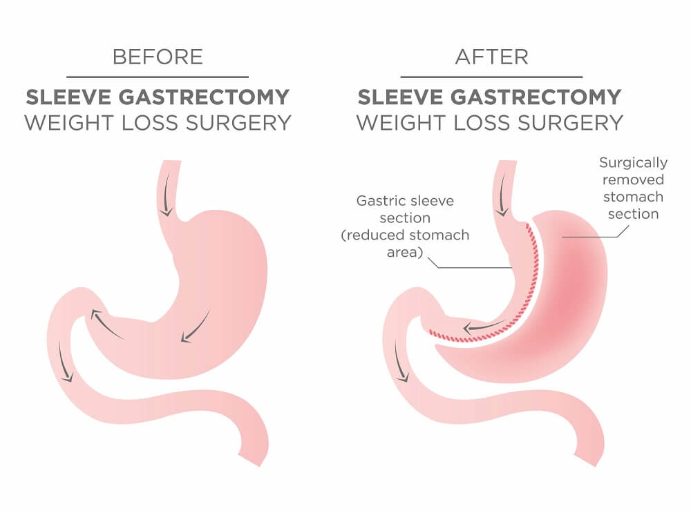 Sleeve Gastrectomy