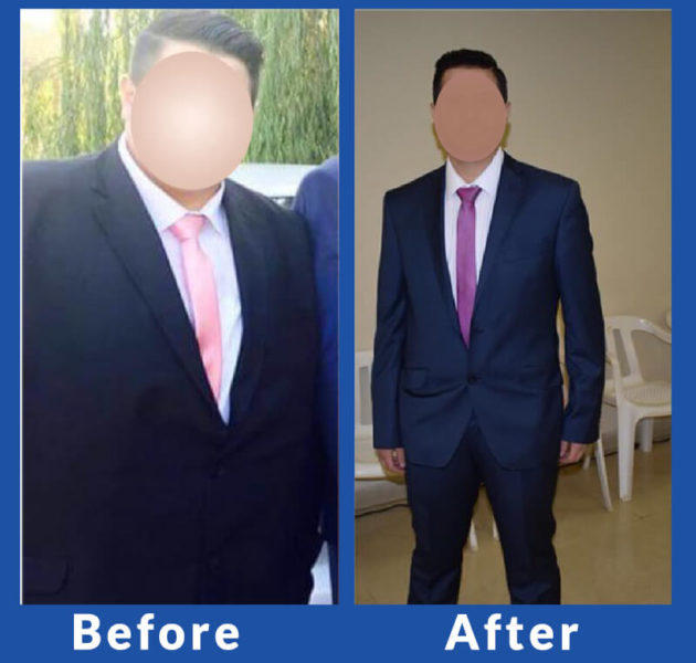 Sleeve Gastrectomy before after