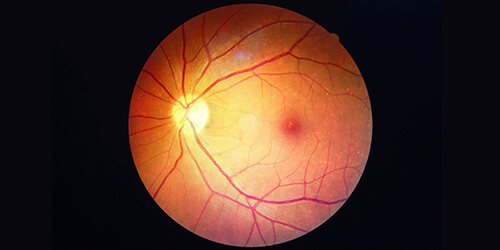 Diabetic retinopathy - Eye Disease Abu Dhabi