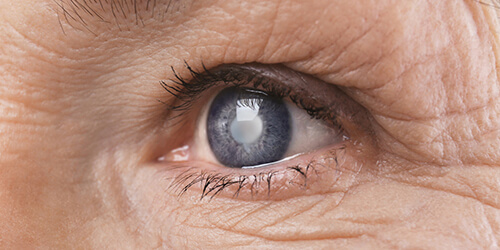 cataract eye treatment Abu Dhabi