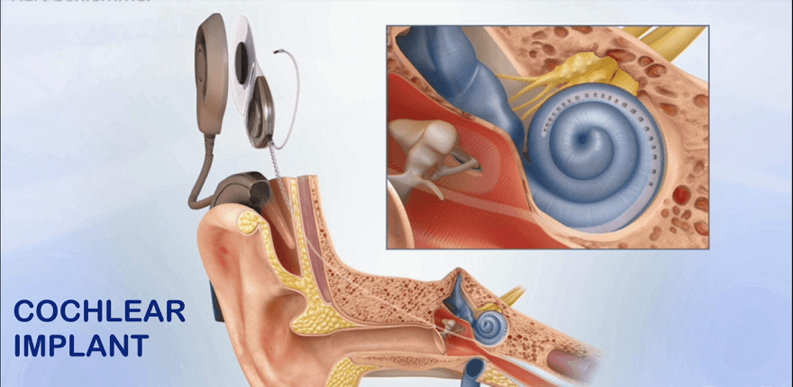 Cochlear Implants Abu Dhabi