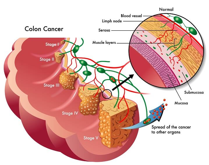 colon cancer