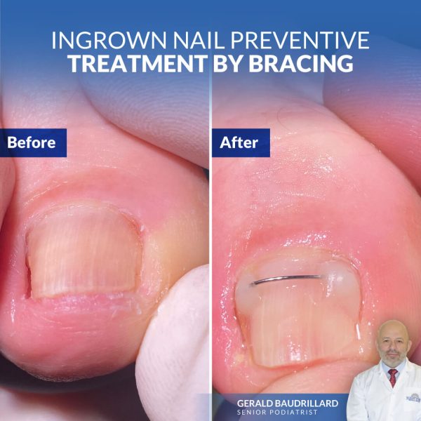 Ingrown Nail Preventive Treatment by Bracing