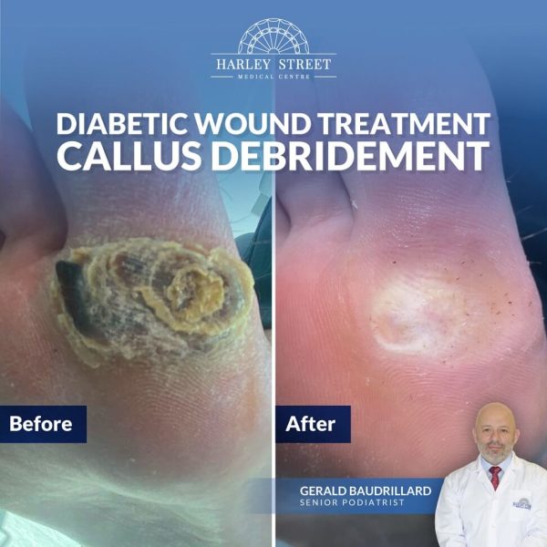 Diabetic wound treatment Callus Debridement Abu Dhabi
