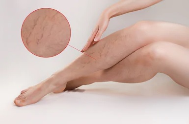 Spider Veins Treatment Abu Dhabi