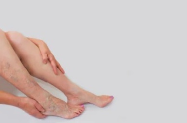 Varicose Veins Treatment Abu Dhabi