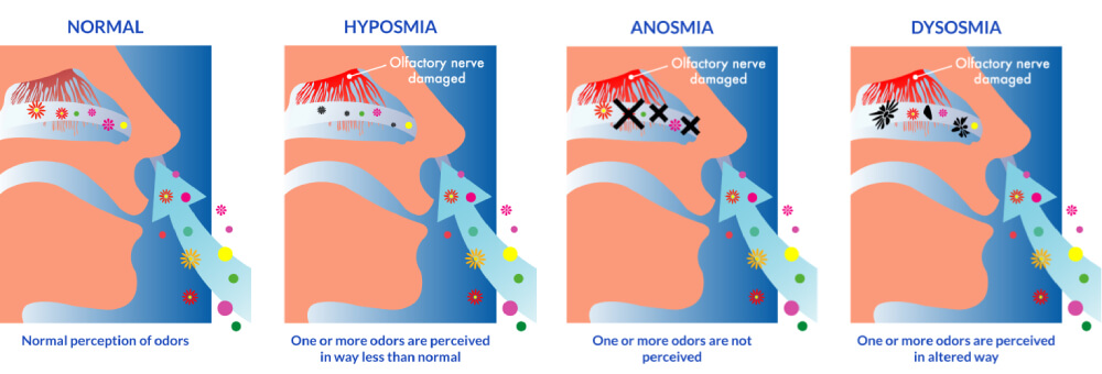 Anosmia Smell nasal disorder treatment Anosmia Smell nasal disorder treatment