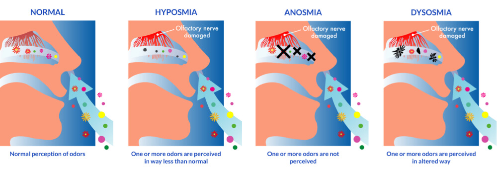 Anosmia Smell nasal disorder treatment