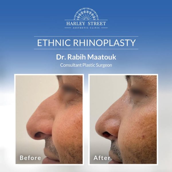 Ethnic Rhinoplasty Ethnic Rhinoplasty