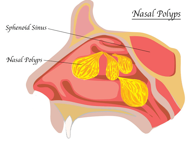 Nasal Polyps Treatment