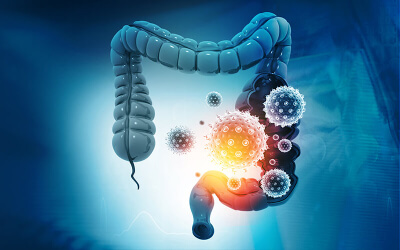 Colon Cancer