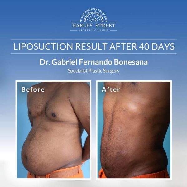 Dr. Bonesana-Liposuction After 40 days
