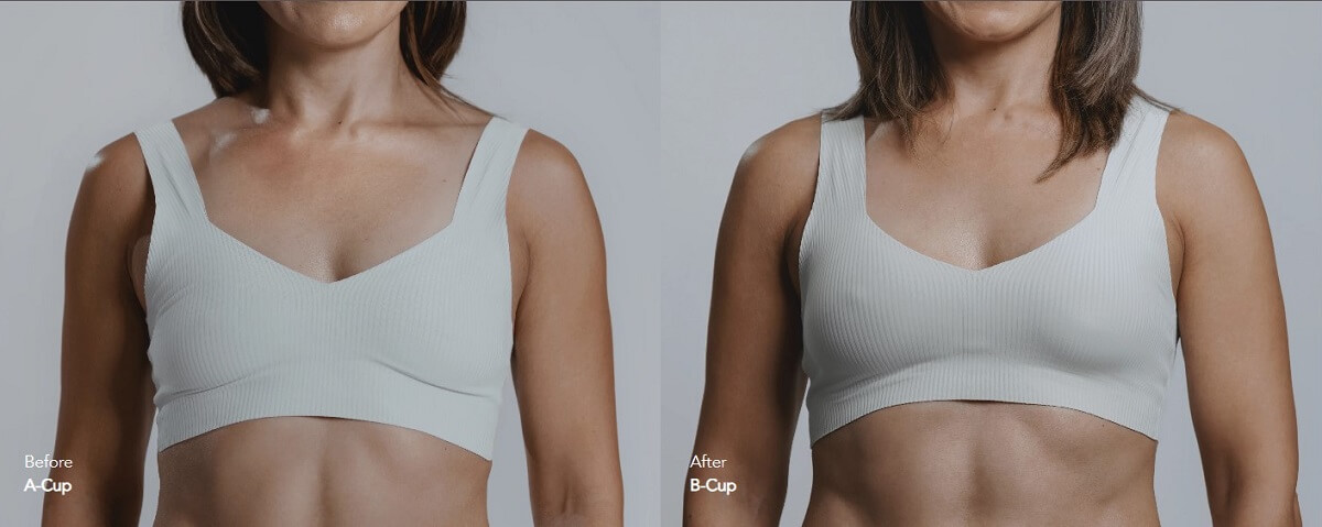 Breast Augmentation Mia Before After Breast Augmentation Mia Before After