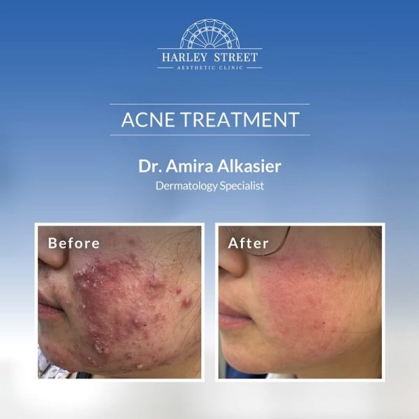 Acne Treatment Acne Treatment
