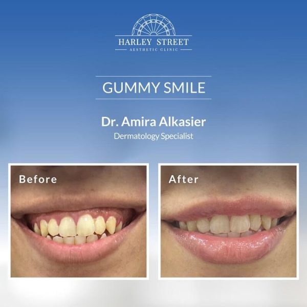 Gummy Smile Gummy Smile
