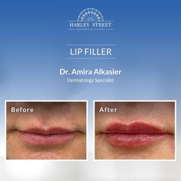 Lip Filler Lip Filler