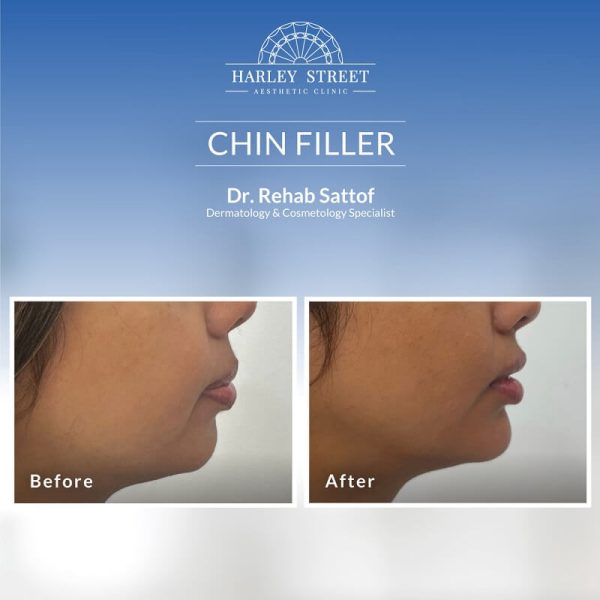 Chin Filler Dr Rehab Abu Dhabi
