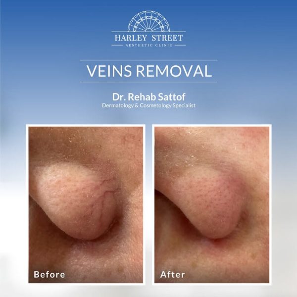 Veins Removal Harley Street Abu Dhabi