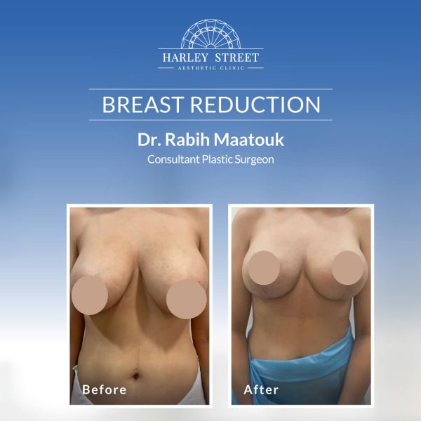 Breast Reduction Breast Reduction