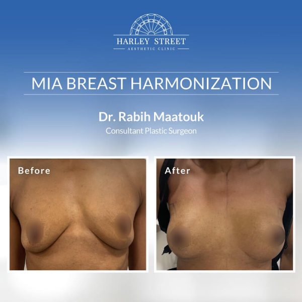 MIA Breast Surgery MIA Breast Surgery