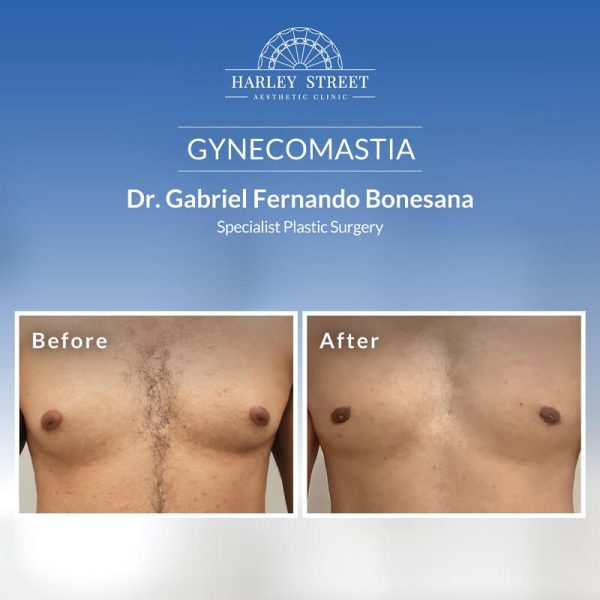 Gynecomastia Abu Dhabi Result Gynecomastia Abu Dhabi Result