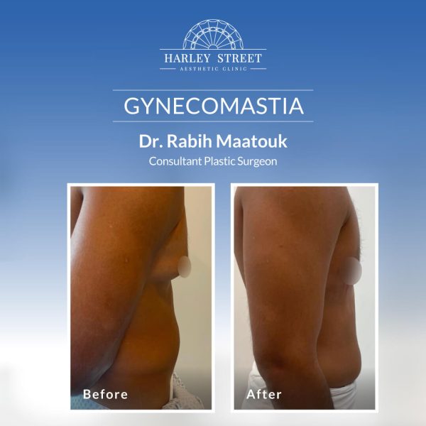 Gynecomastia Before After Abu Dhabi Gynecomastia Before After Abu Dhabi