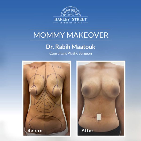 Mommy makeover Abu Dhabi Mommy makeover Abu Dhabi