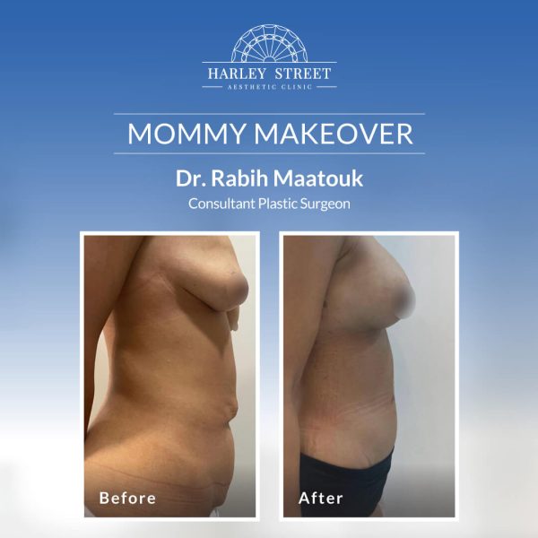 Mommy Makeover Abu Dhabi