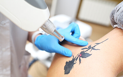 Laser for tattoo removal