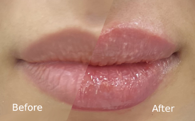 Lip Filler Abu Dhabi