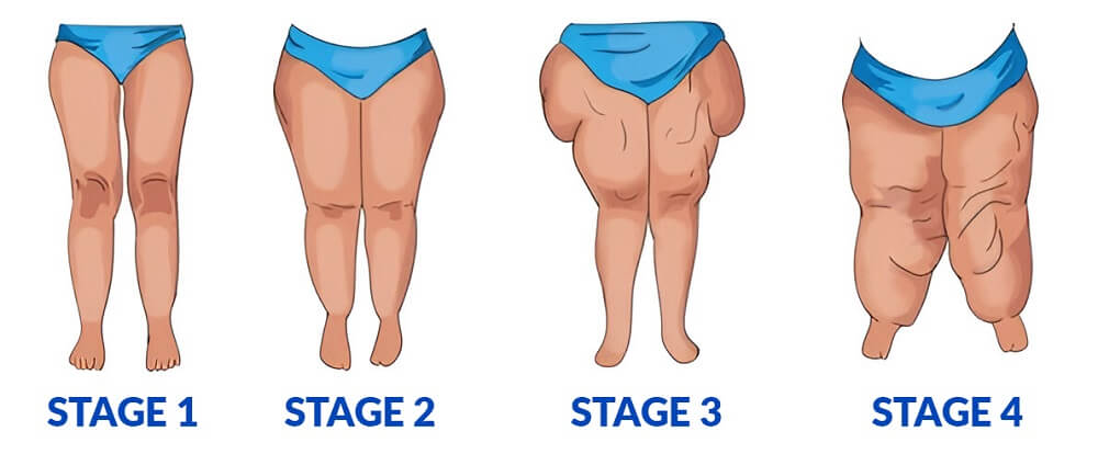Stages of Lipedema