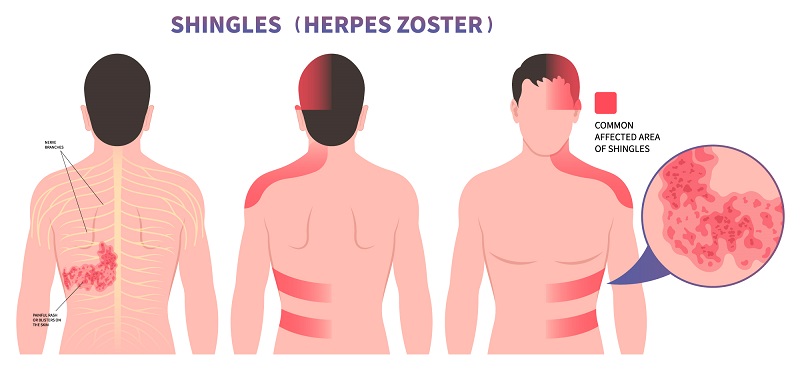 Shingles Symptoms