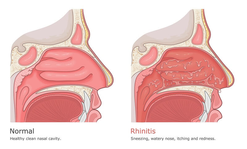 Treatment for Rhinitis Abu Dhabi